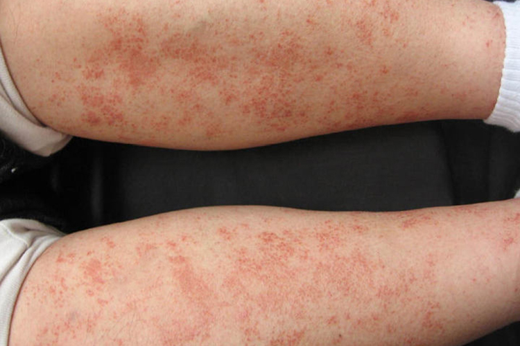 出血点或淤斑图