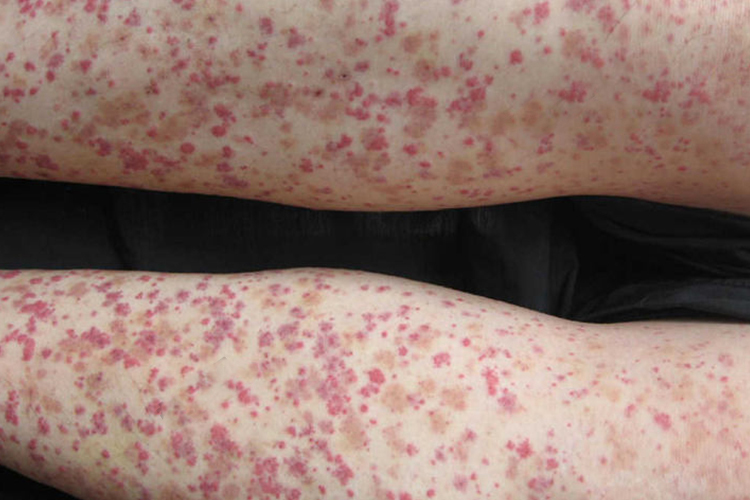 散在淤点或风团样皮疹图